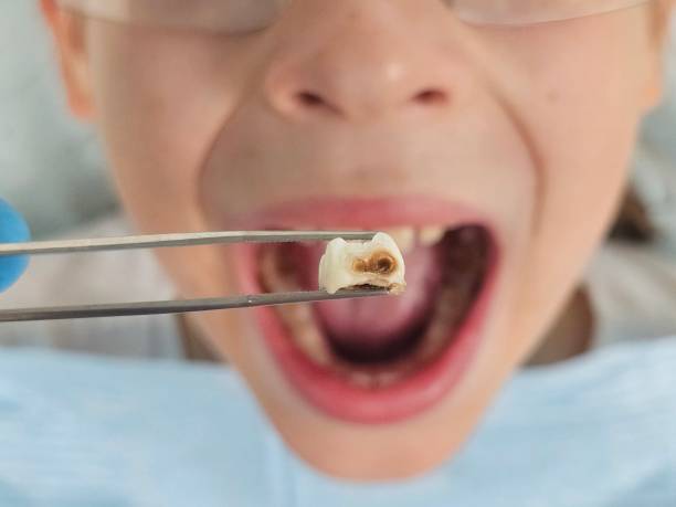 Best Emergency Dental Extractions in Malta, IL